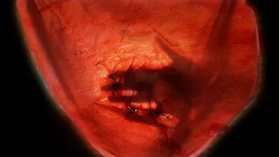 It's Stonewall in My Navel