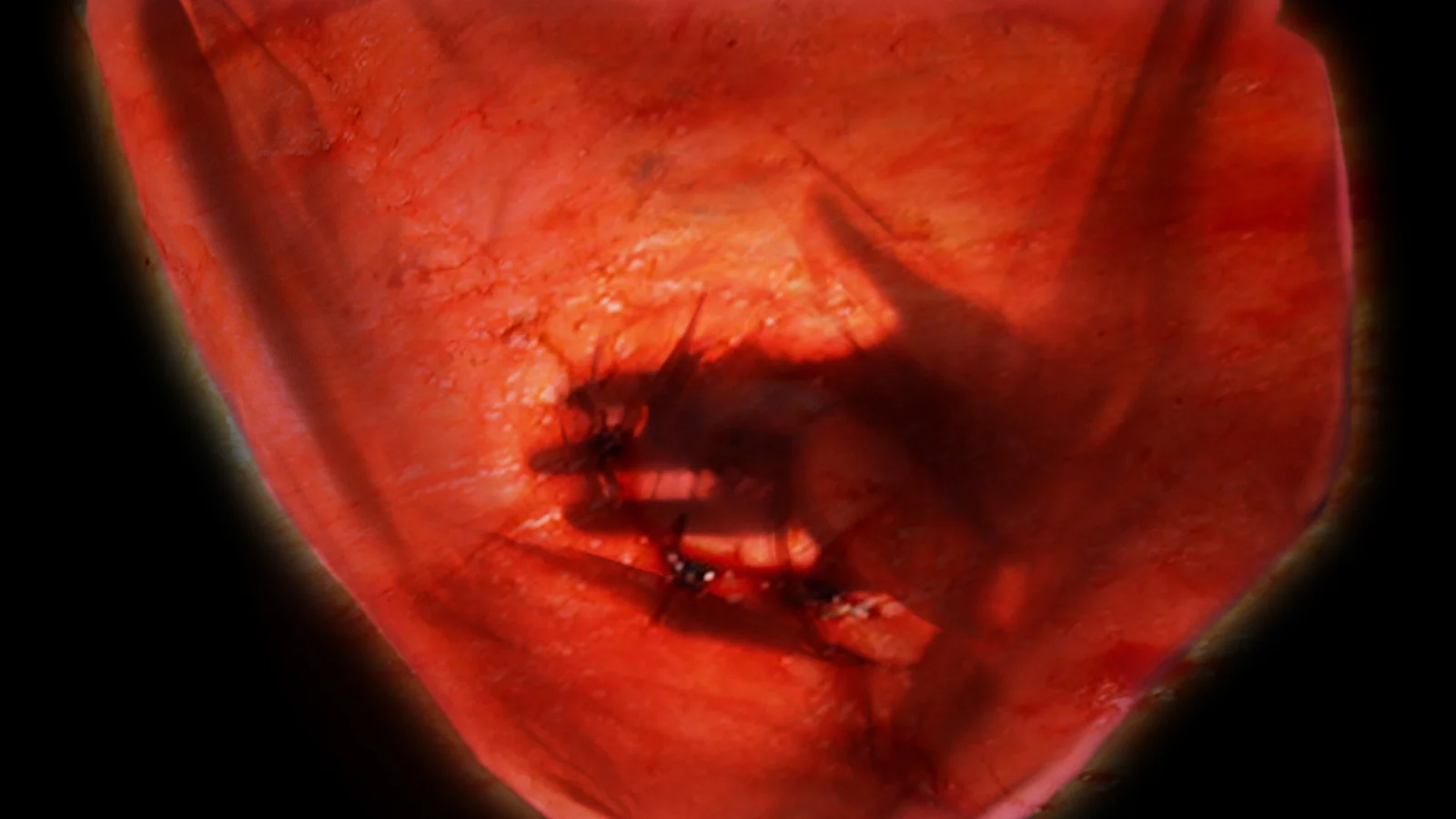 It's Stonewall in My Navel